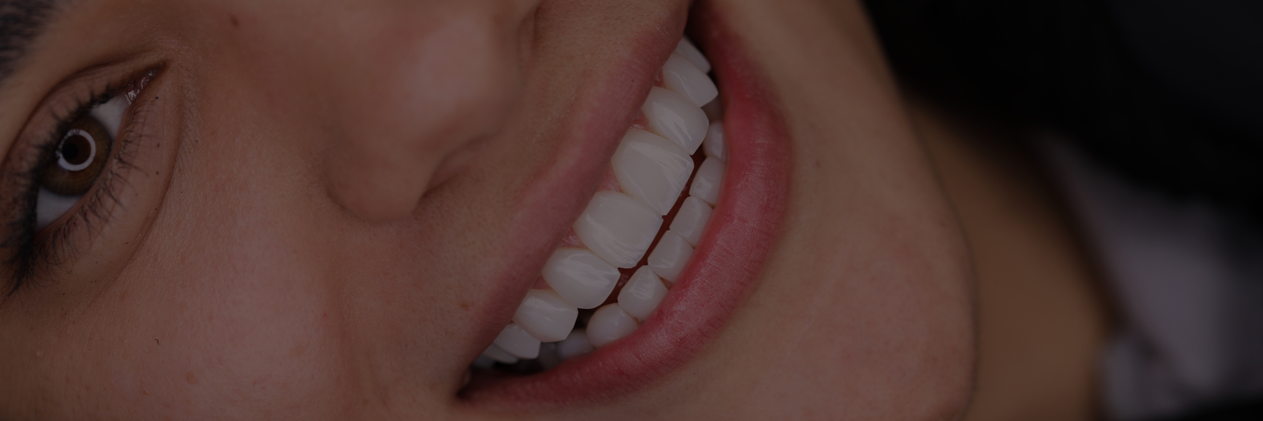 بازسازی لبخند با ونیرکامپوزیت