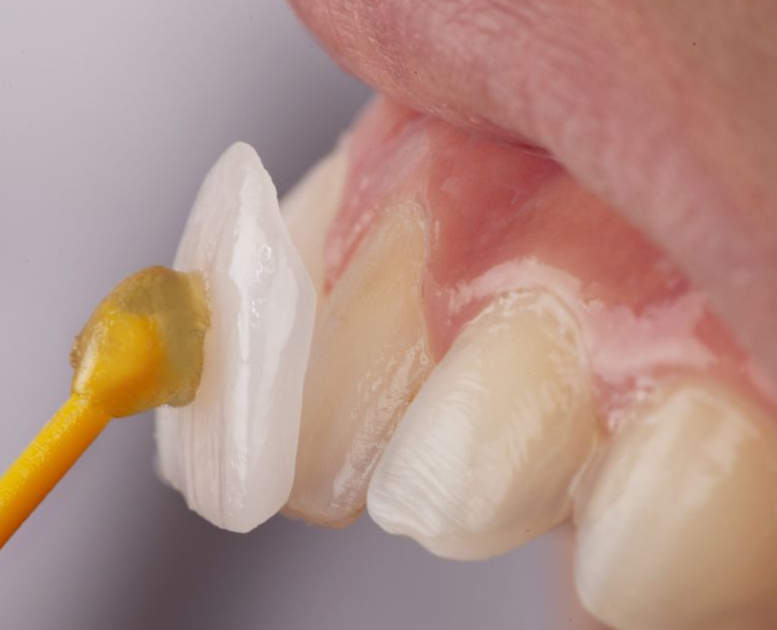 لمینت های سرامیکی